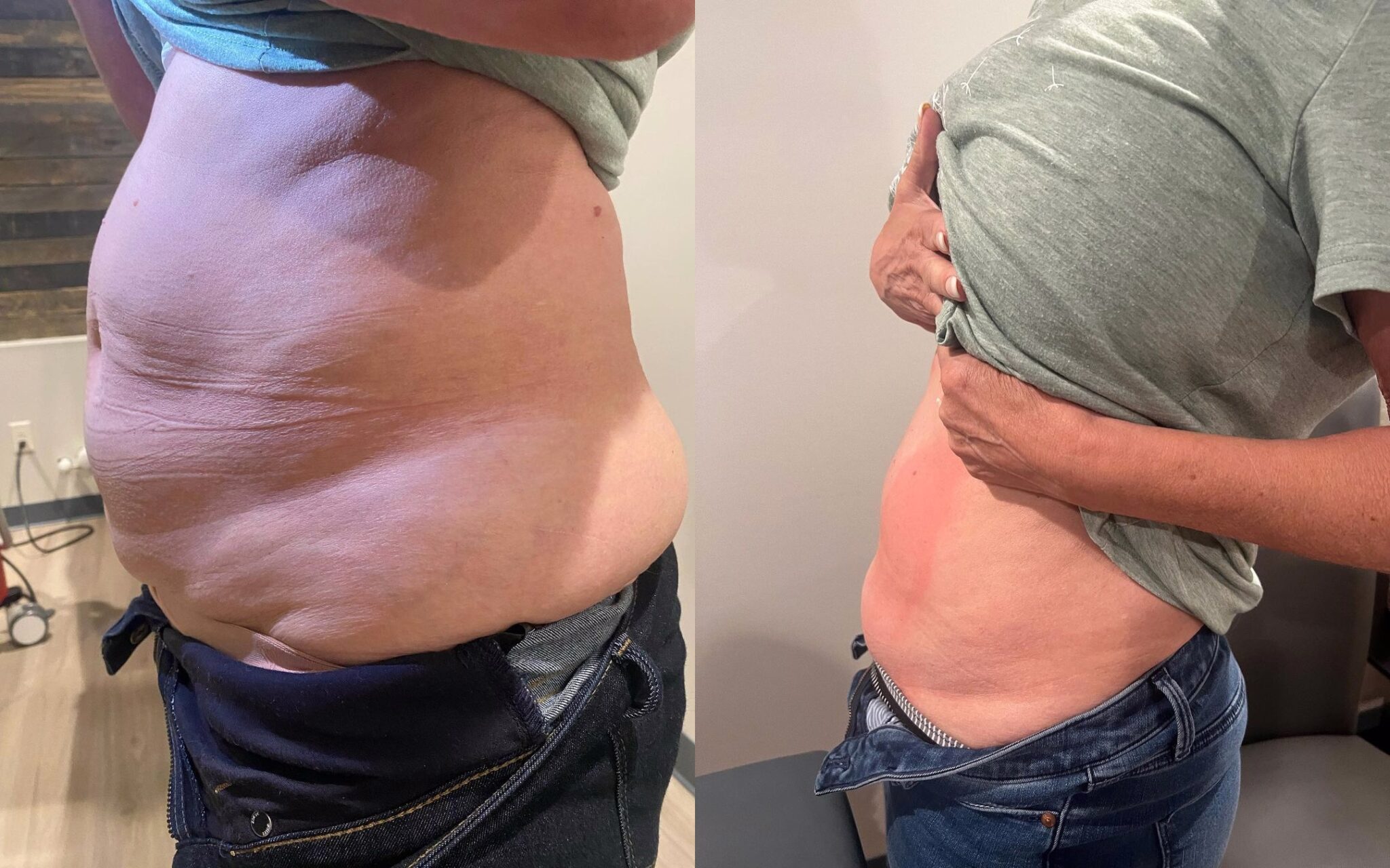 Body Contouring Landing Page in Waxhaw, NC The Regenerative Center Spa